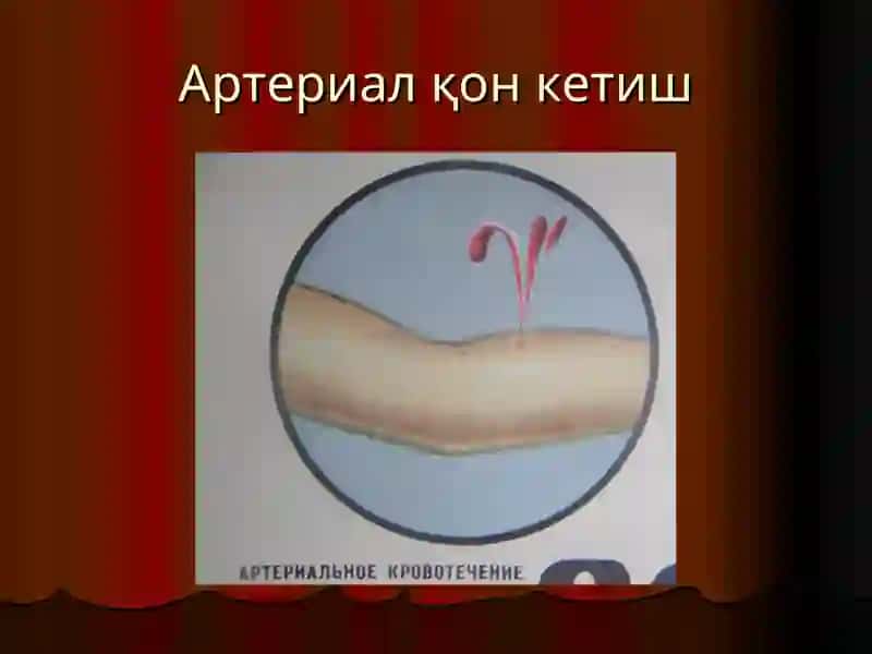 Qon ketish va uni to'xtatish usullari | Қон кетиш ва уни тўхтатиш усуллари 4