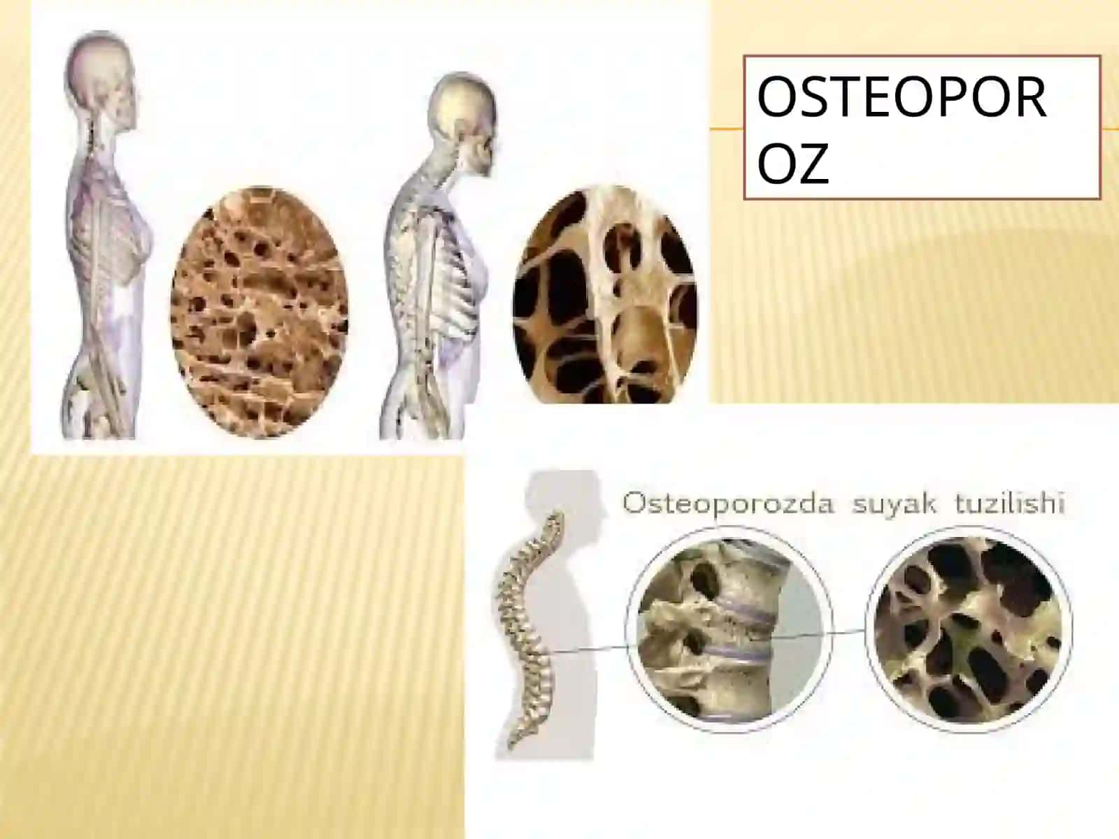 Osteoporoz 4