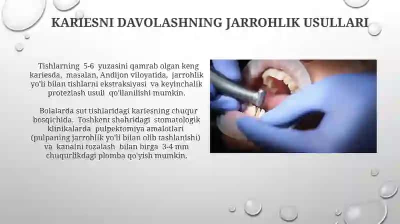 Kariesni davolash usullari 4