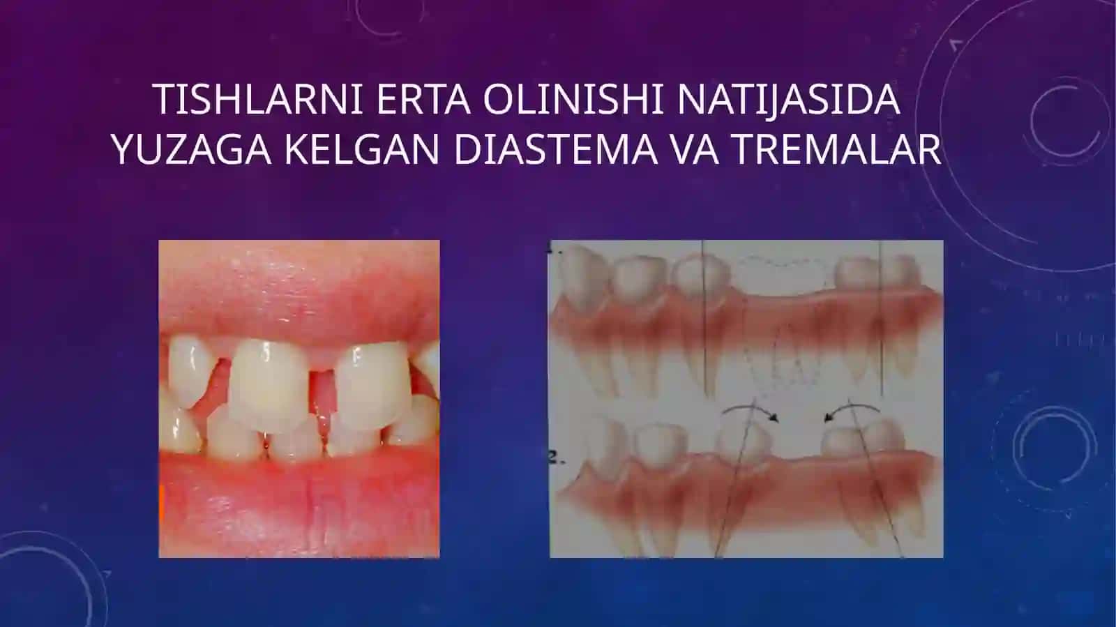 Tishlarni erta olinishi natijasida yuzaga kelishi mumkin boʻlgan asoratlar 4