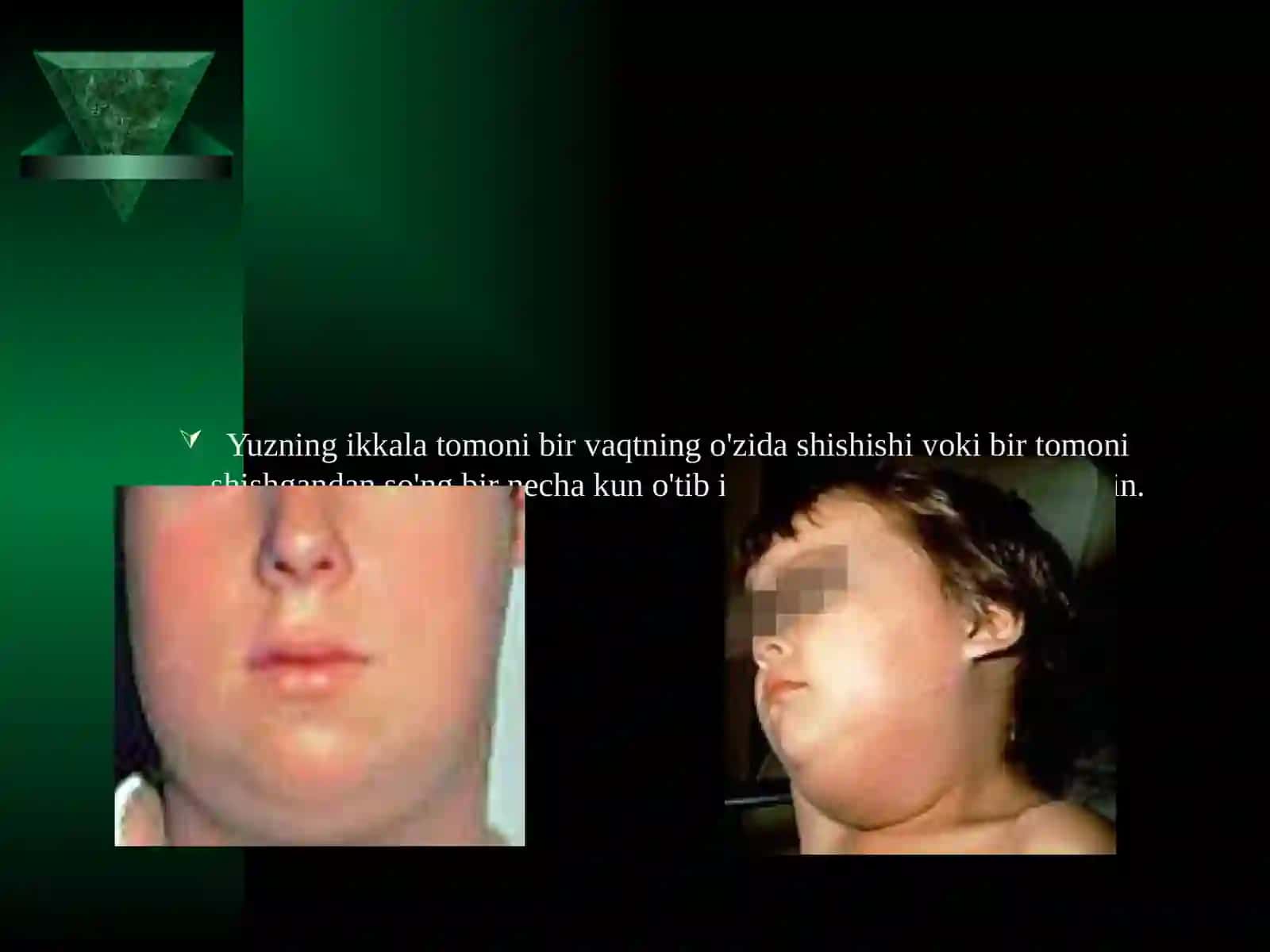 Epidemik parotit (tepki) kasalligi va asoratlari 4