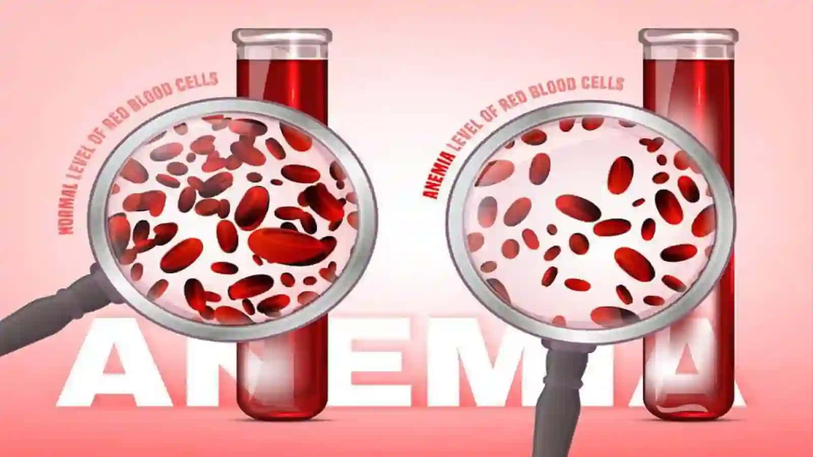 Surunkali kasalliklar anemiyasi 4