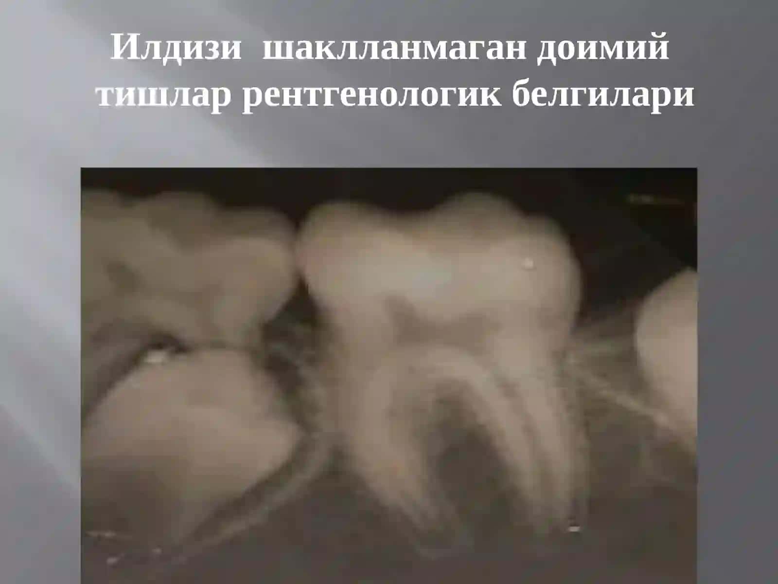 Илдизиш ақлланмаган доимий тишлар 4