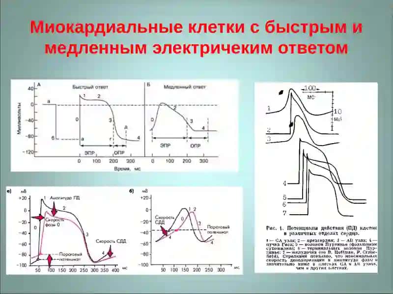 ЭКГ диагностика аритмий 4