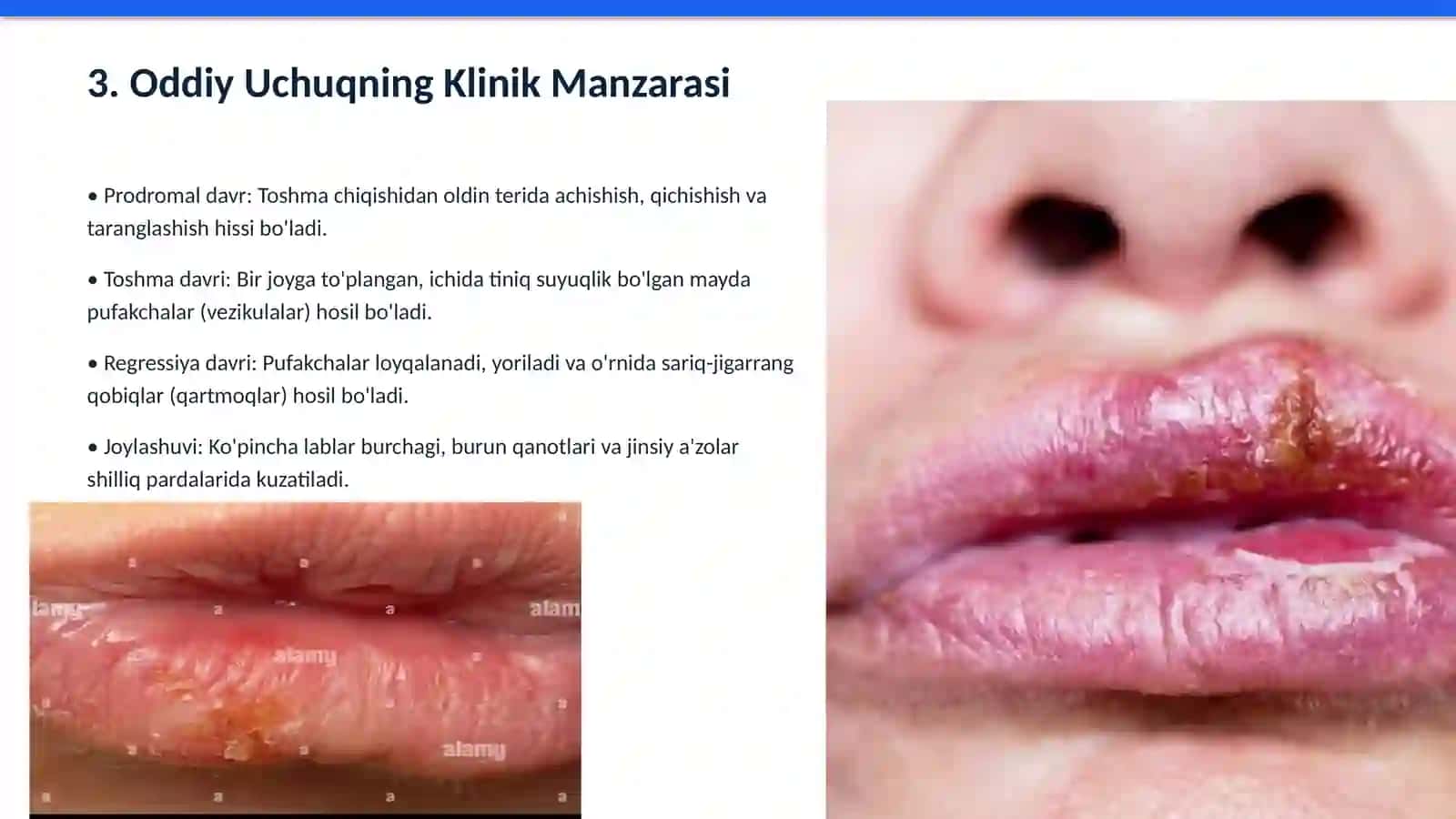 Terining Virusli Kasalliklarida Hamshiralik Ishi 4
