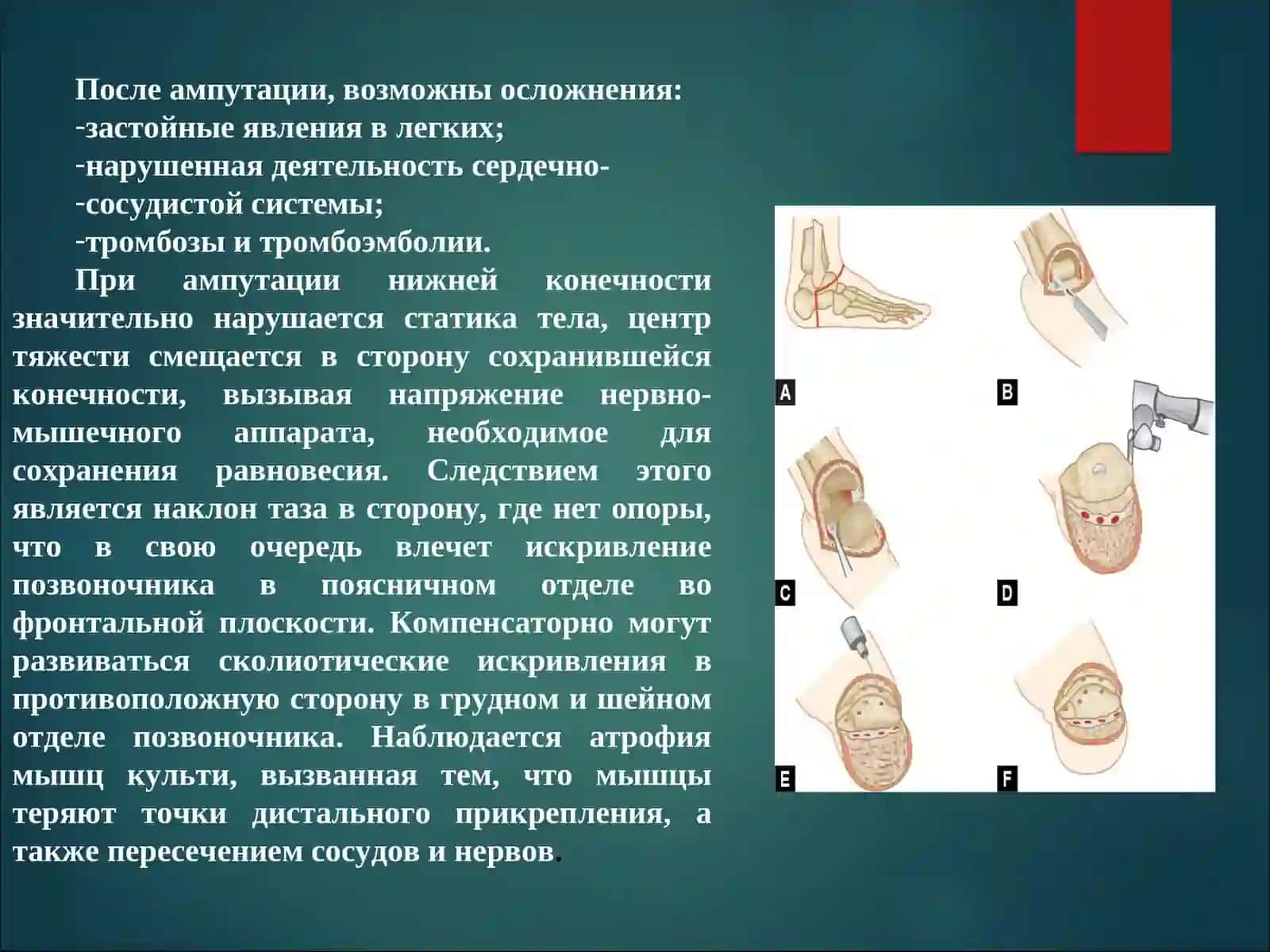 Ампутация протезирование и реабилитация инвалидов 4