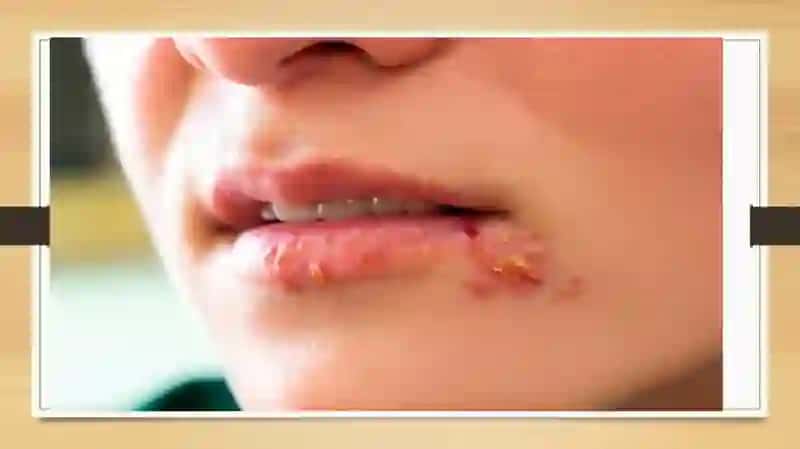 Oddiy Uchuq (Herpes Simplex) 4