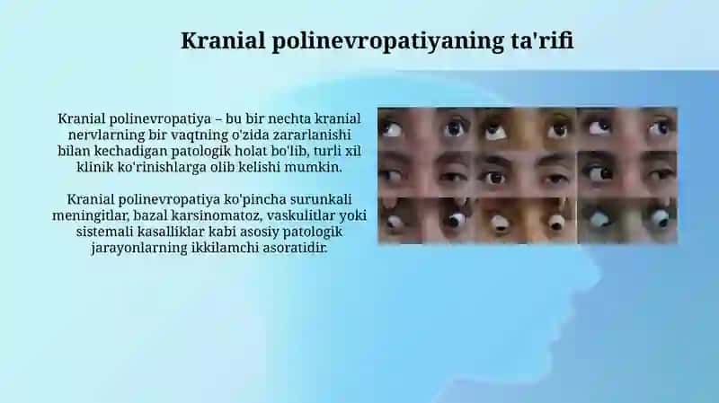 Kranial polinevropatiya 4