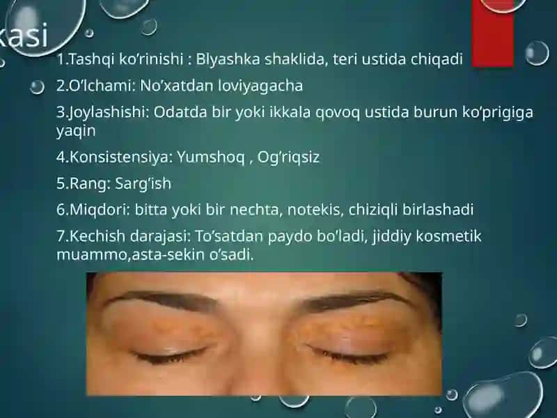 Ksantelazma.Lipoma.Gigroma 4