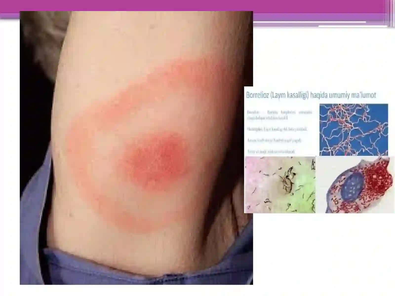 Borrelioz(laymakasalligi) Leotospiralarmarfologiyasi 4