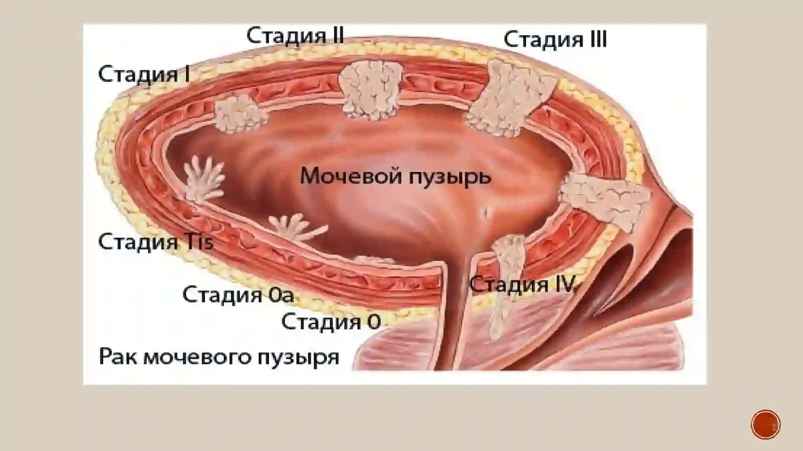 Qovuq raki haqida umumiy ma’lumot 4