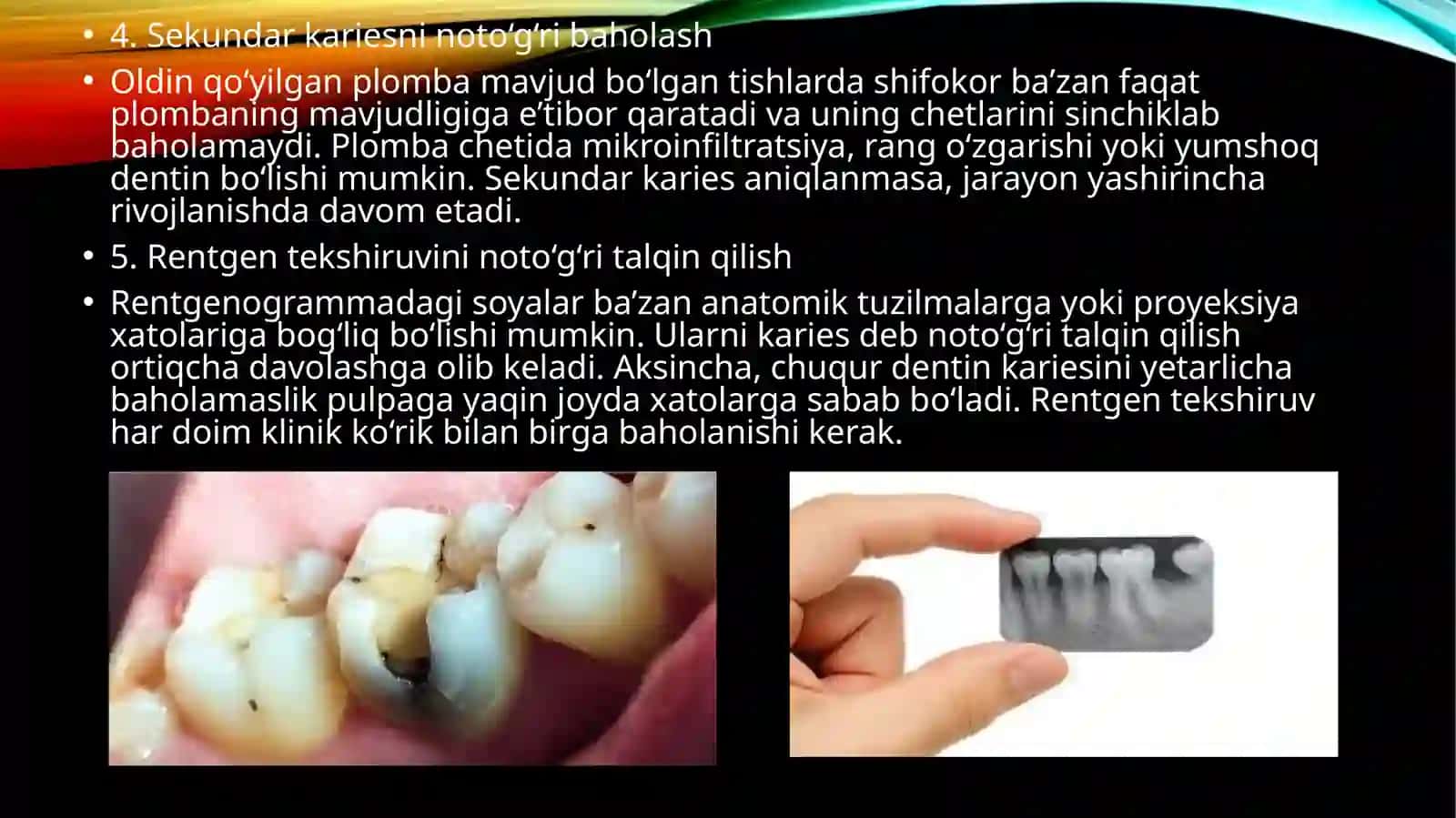 Kariyes kasalligini tashxislashda va davolashda uchraydigan xato va asoratlar.Kariyes kasalligini profilaktikasi.Kariyesni profilaktik omillar guruhi haqida malumot 4