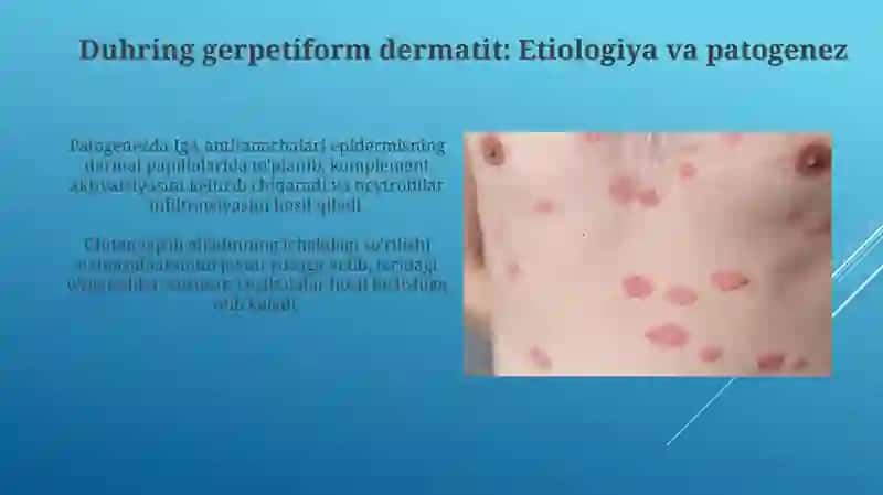 Pufaklidermatozla.Akontalitikpo'rsildokyara.Dyurinubguchuqsilomdermatiti 4