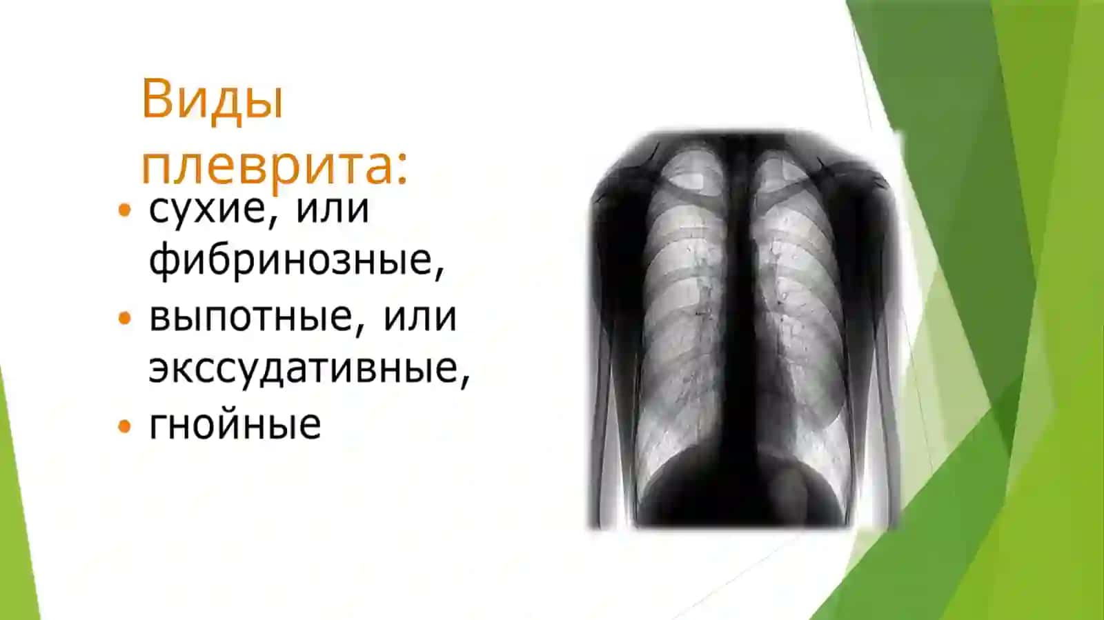 Плеврит 4