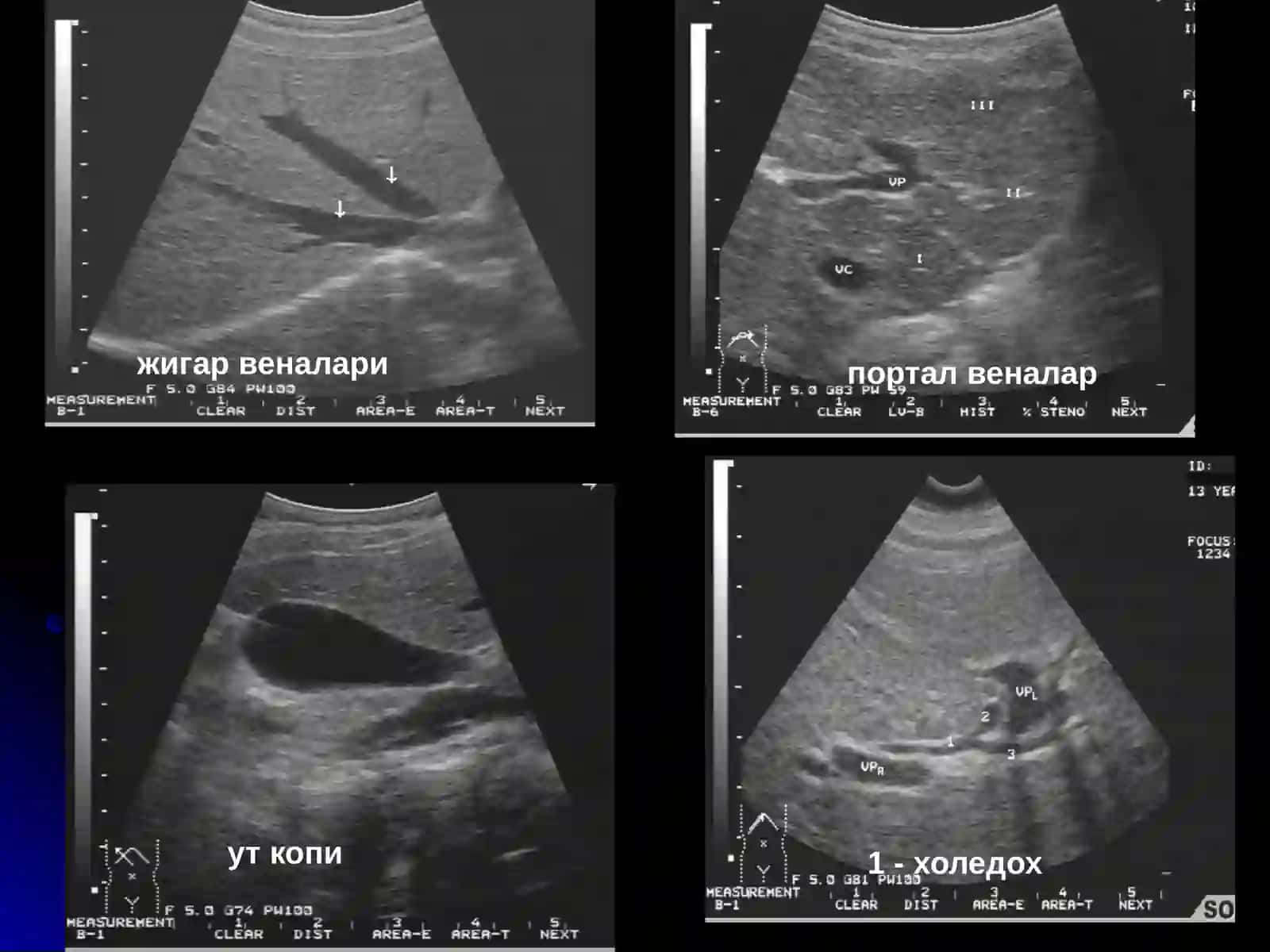 Жигар ва ут йуллари касалликларининг нур ташхиси 4