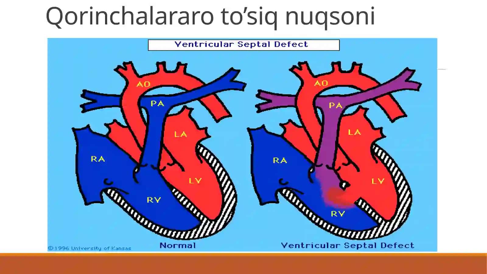 Yurak  poroklari(nuqsonlari). Porokturlari, ularda qon  aylanishning asosiy ko’rinishlari 4