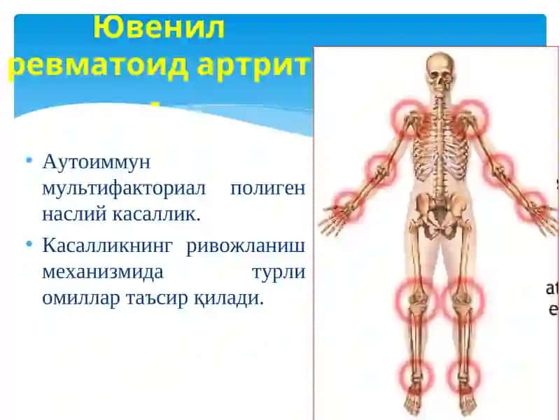 ЮВЕНИЛ РЕВМАТОИД АРТРИТ 4