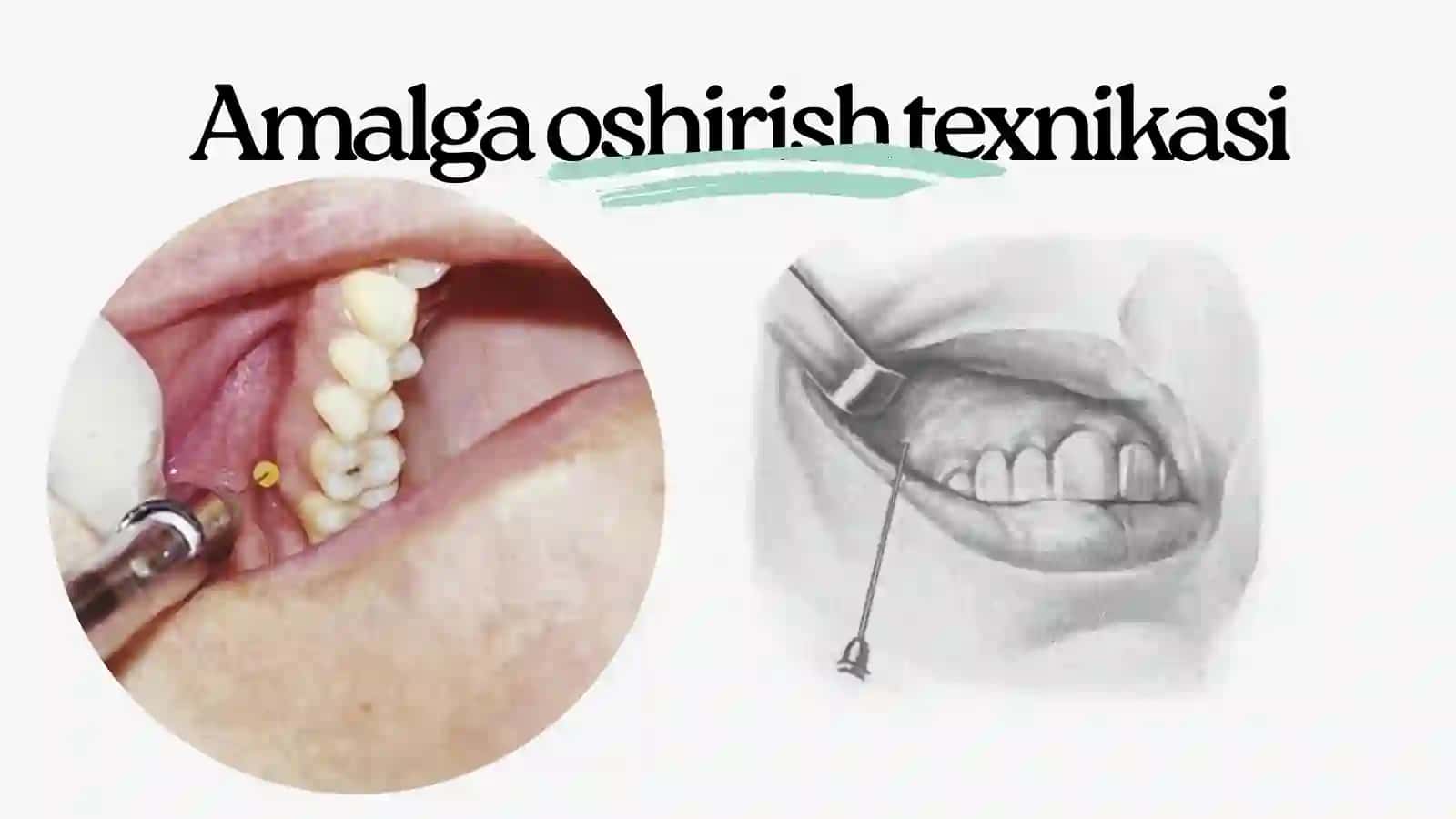 tuberal anesteziya 4