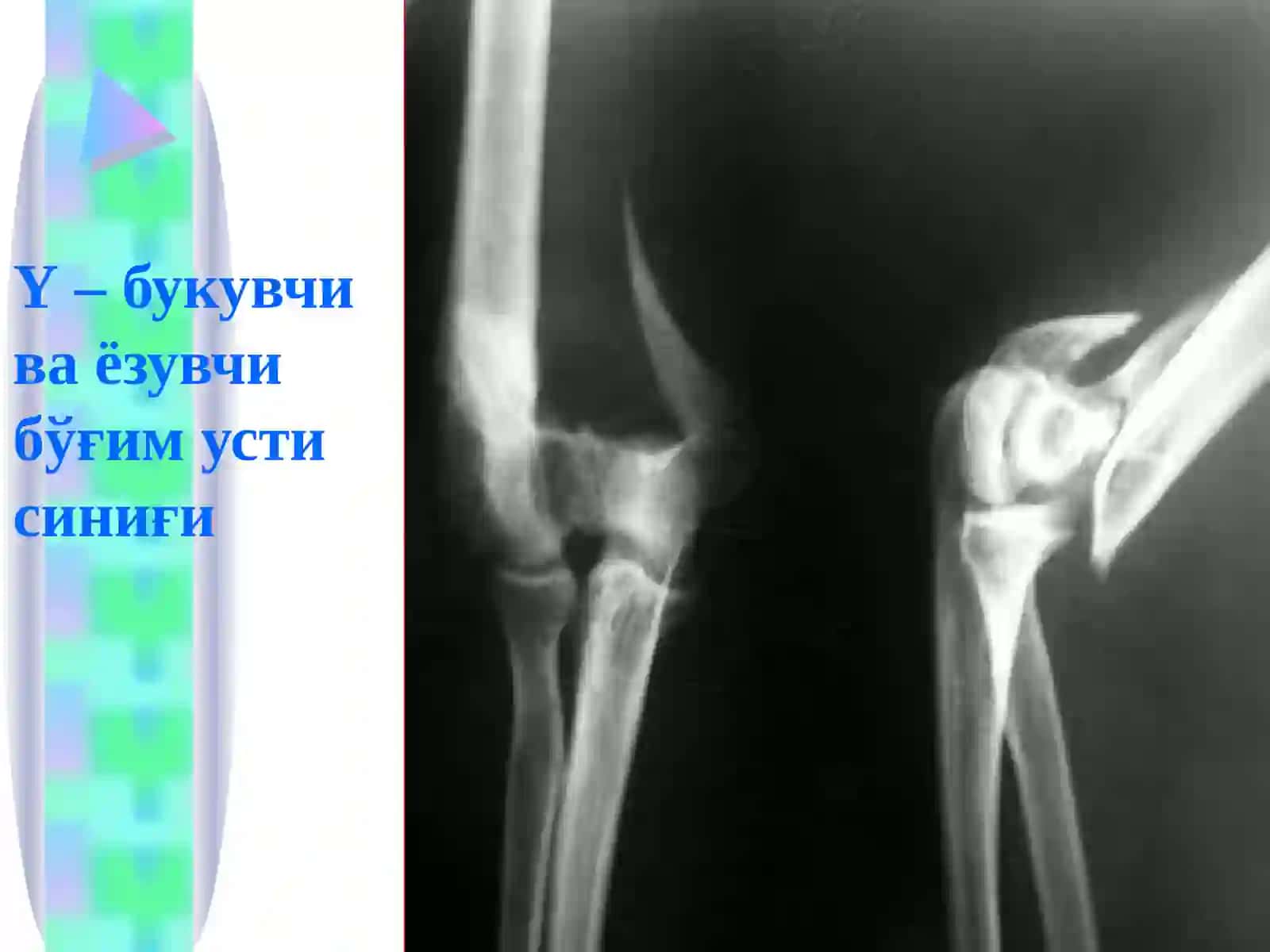 елка билак Шикастлари 4