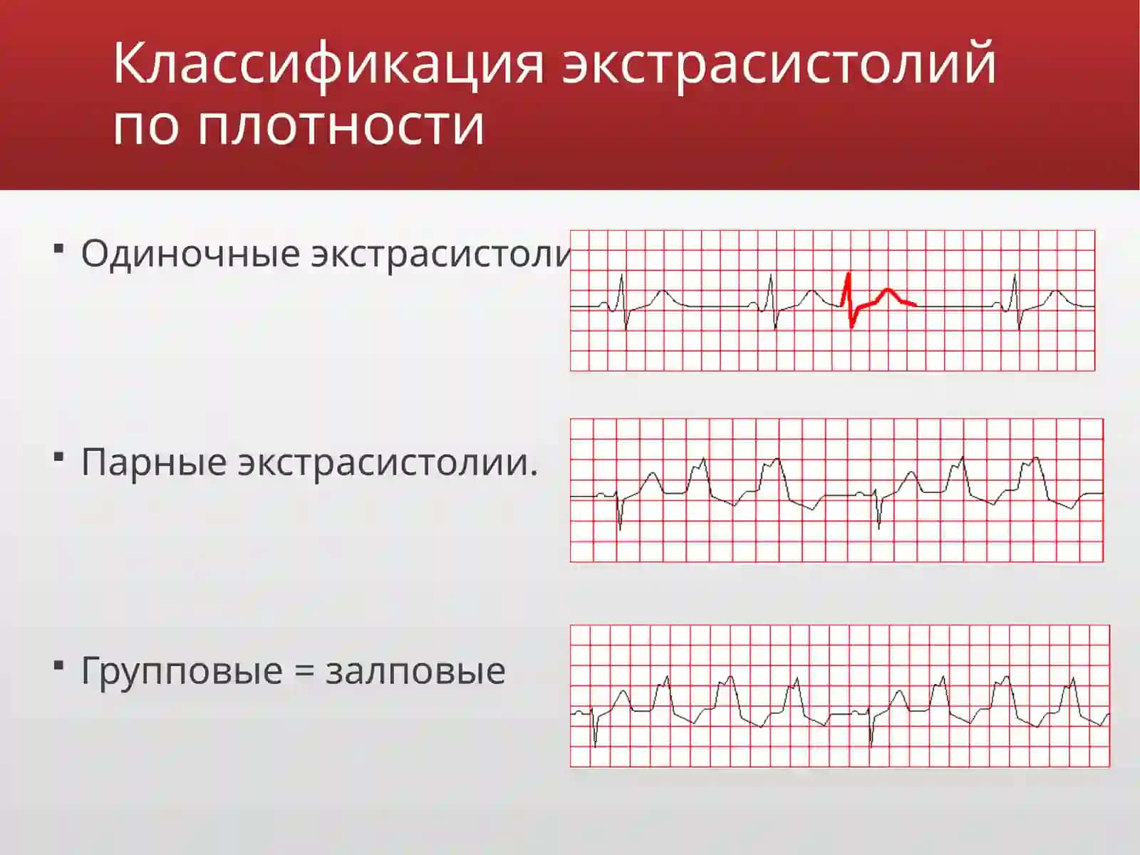 Экстрасистолия 4