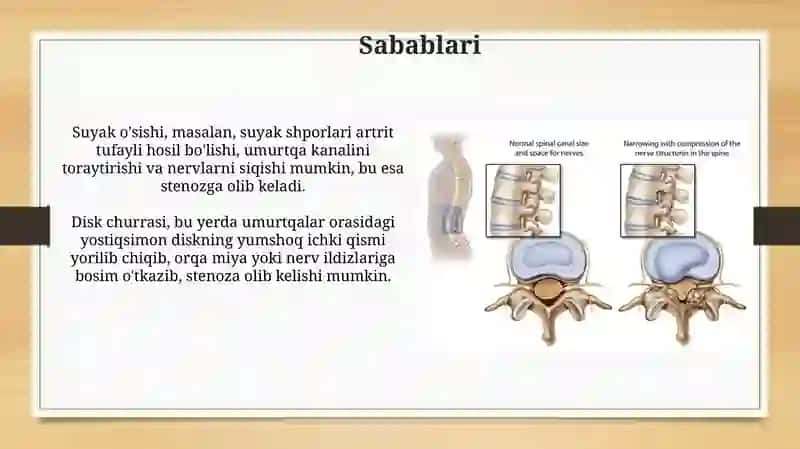 Umurtqa kanali stenozi 4