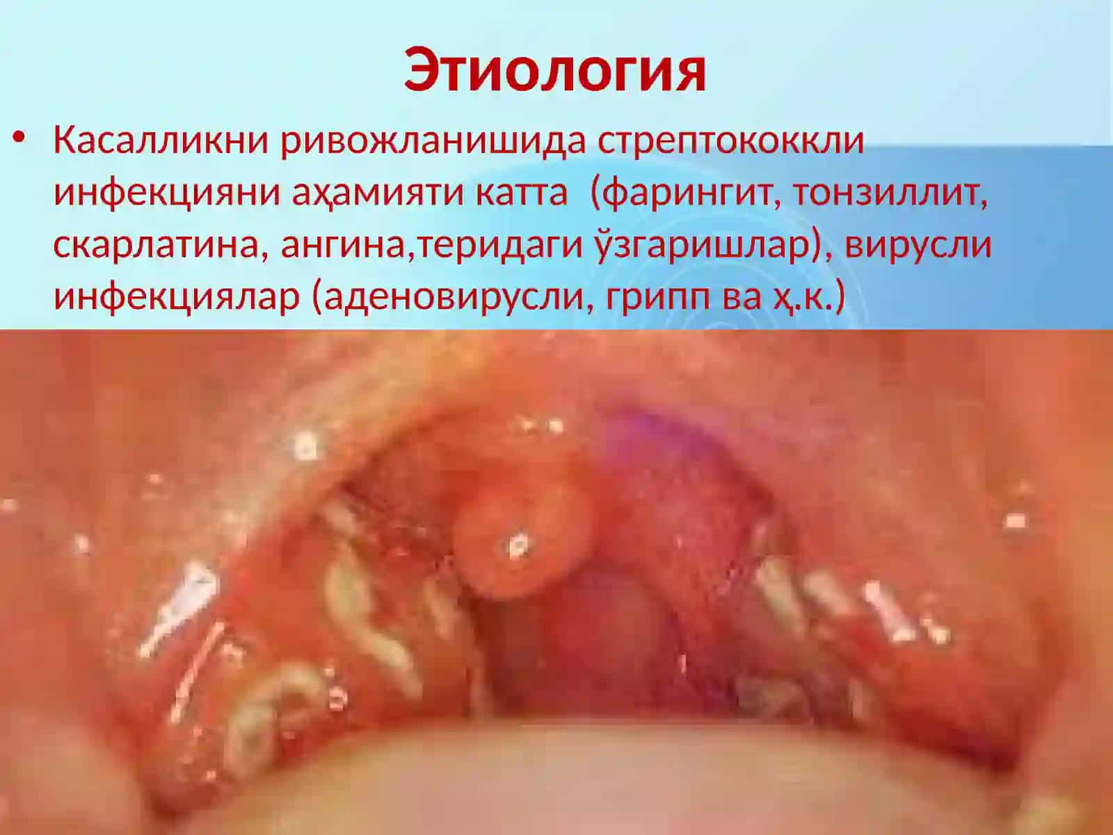 Гломерулонефрит 4