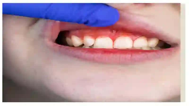 Bolalarda Vensan gingivo-stomatiti 4