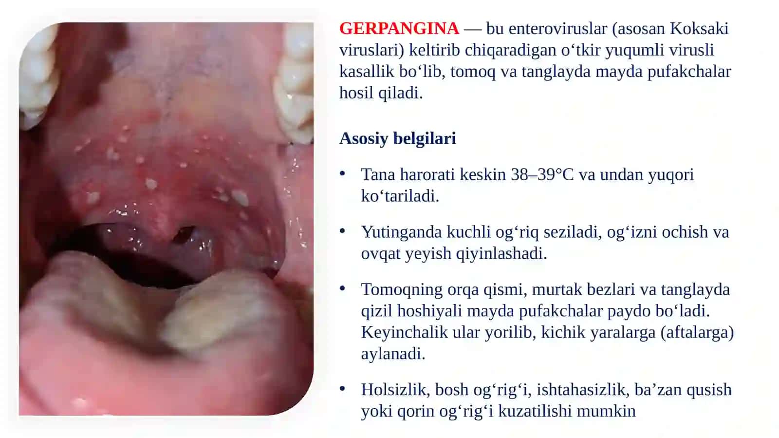 BOLALARDA OG‘IZ BO‘SHLIG‘I SHILLIQ QAVATINING O‘TKIR YUQUMLI KASALLIKLARNING (GERPANGINA, SKARLATINA, BO‘G‘MA) O‘ZGARISHLARI, KLINIK KECHISHI, TASHXISI VA DAVOSI 4