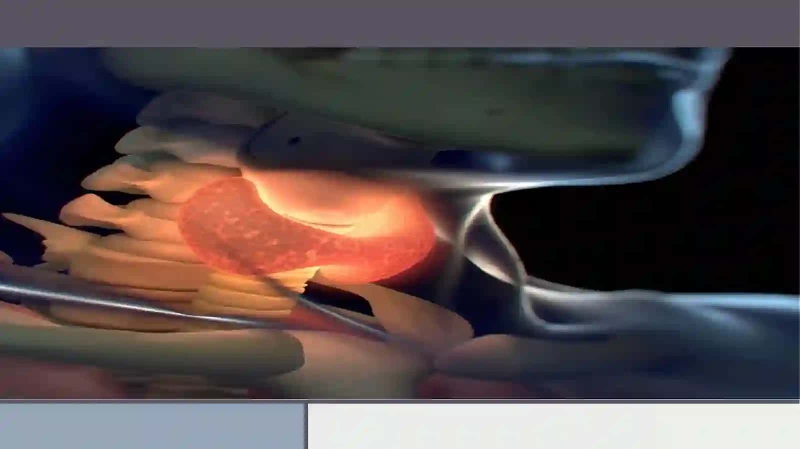 Tireotoksikkriz 4