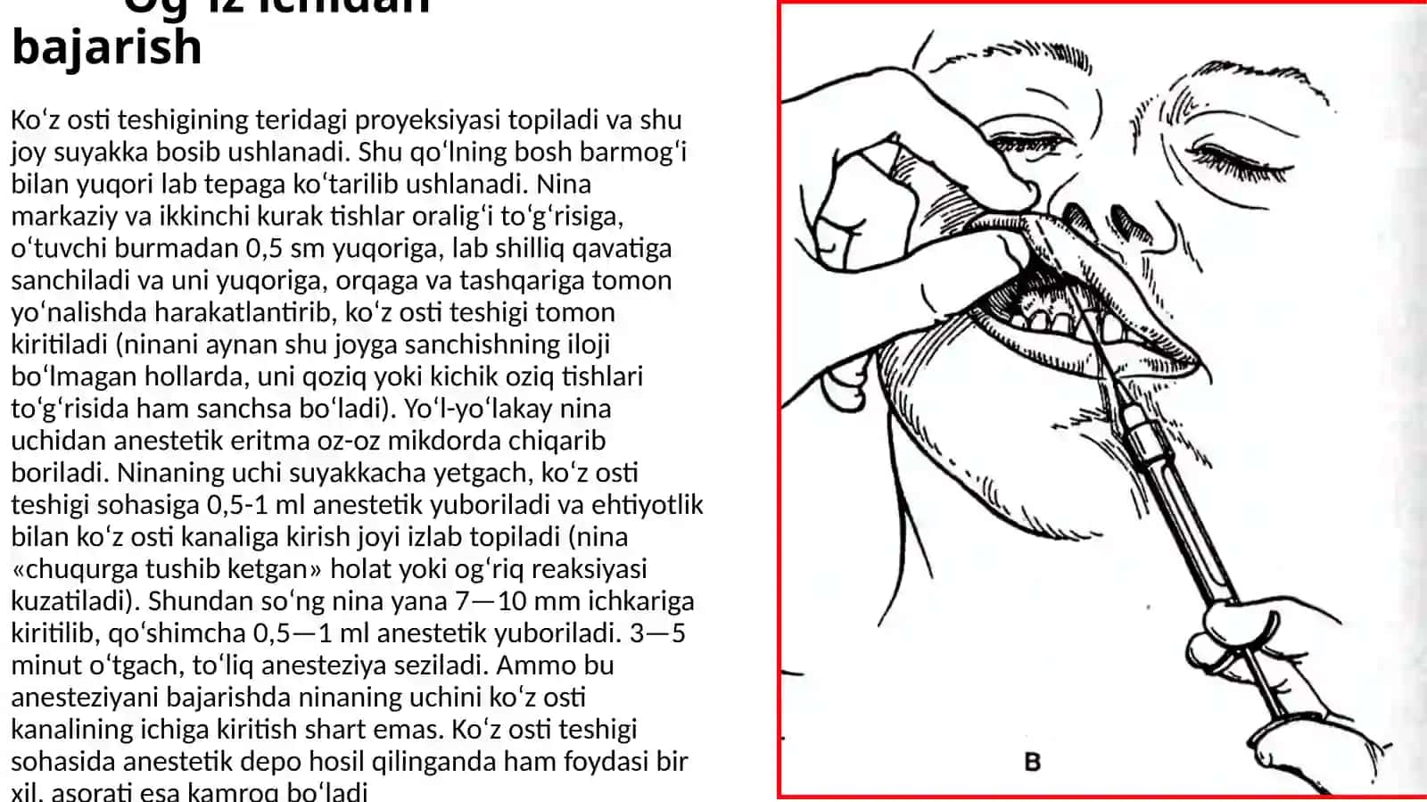 Xirurgik stomatologiya polikilinkasida qo‘llaniladigan og‘riqsizlantirish usullari 4
