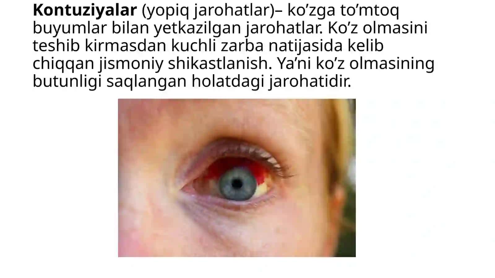 Ko’ruva’zosijarohatlari.Kontuziyalar 4