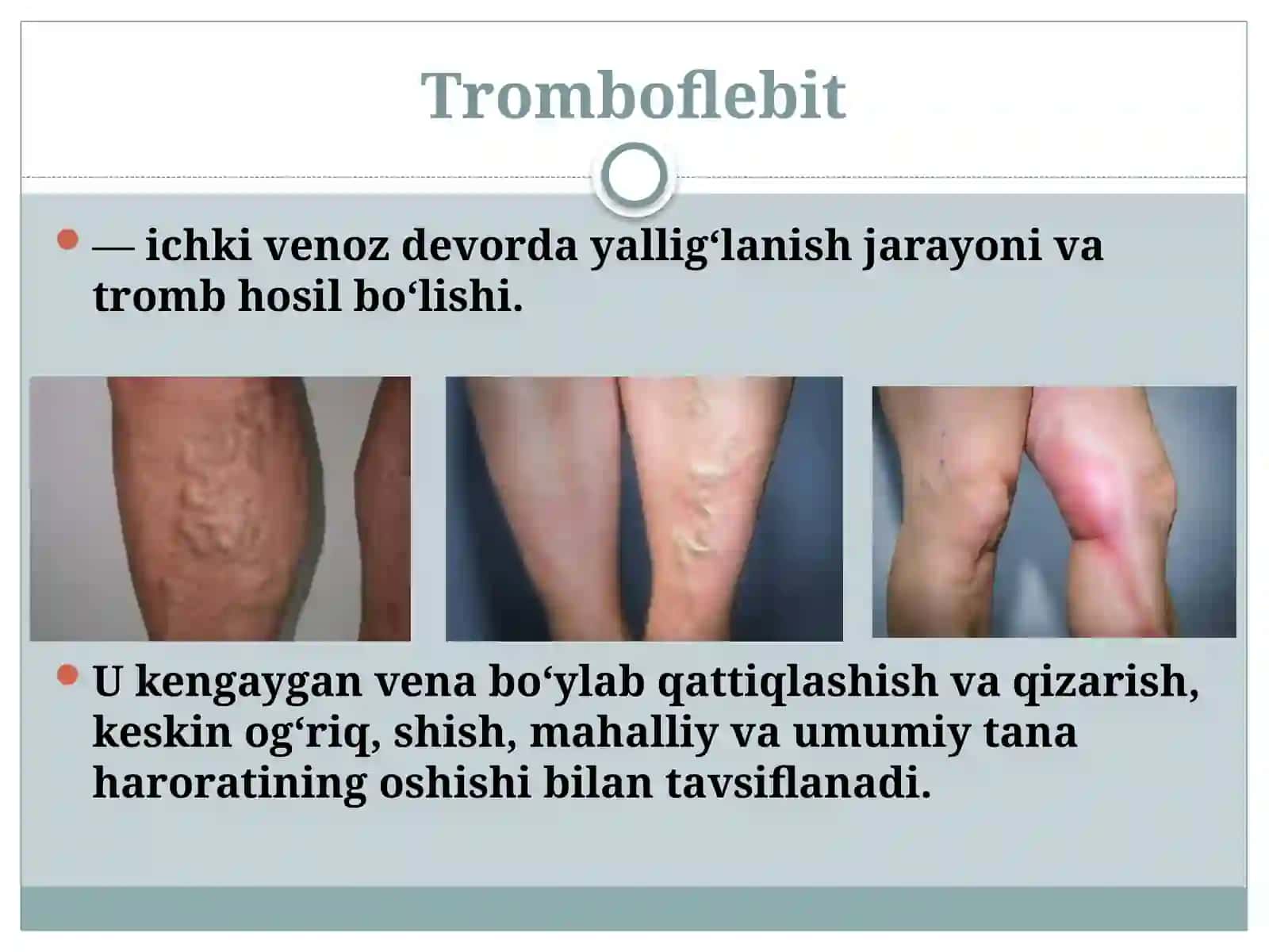 Tromboflebitva flebotromboz 4