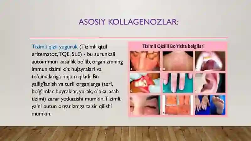 Kollogenozlar, patogenezi va tashxisi 4