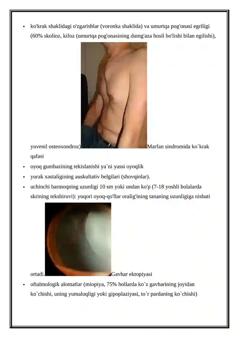 MARFAN SINDROMI 4
