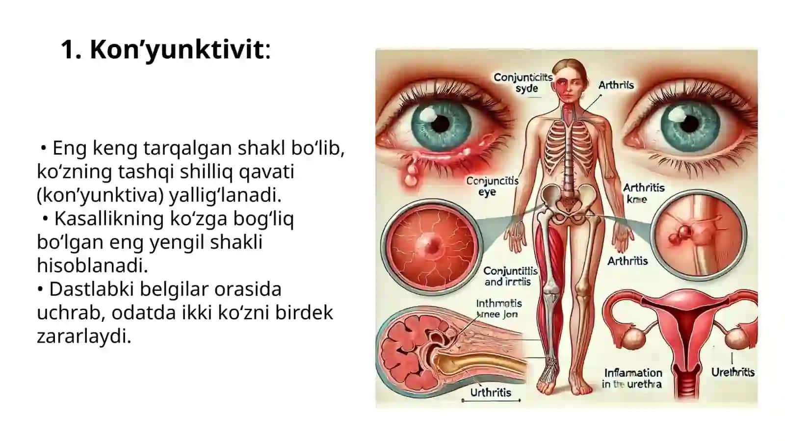 Reiter sindromi 4
