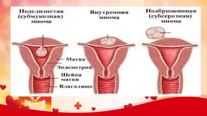 Bachadon miomasi 4