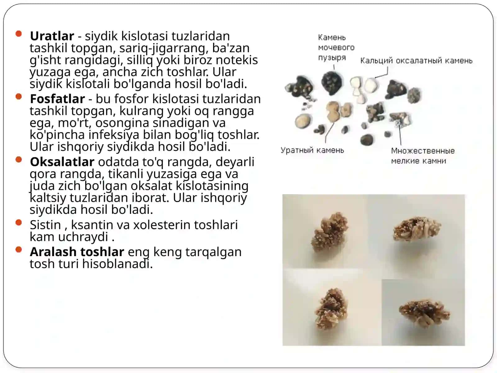 Siydik tosh kasalligi. Urolitiaz 4