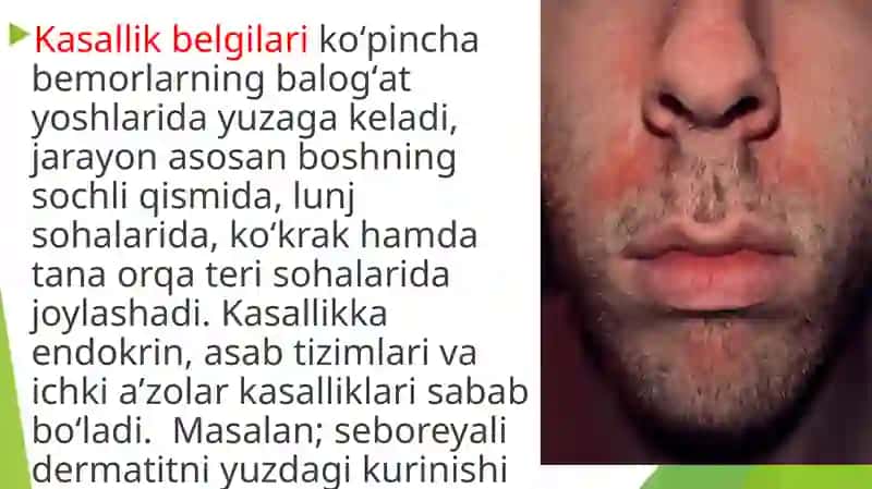 Seboreya. Pushti rangli xusnbuzarlar. Chaqaloqining yiringlikasalliklari. Layell va Stivens-Djonson 4
