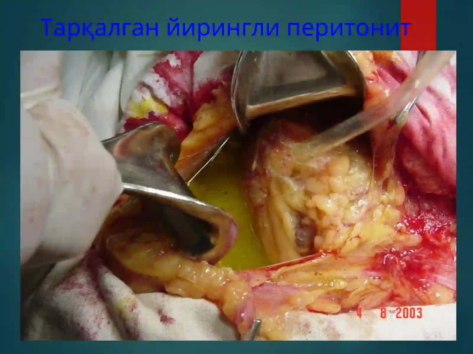 уткир перитонит 4