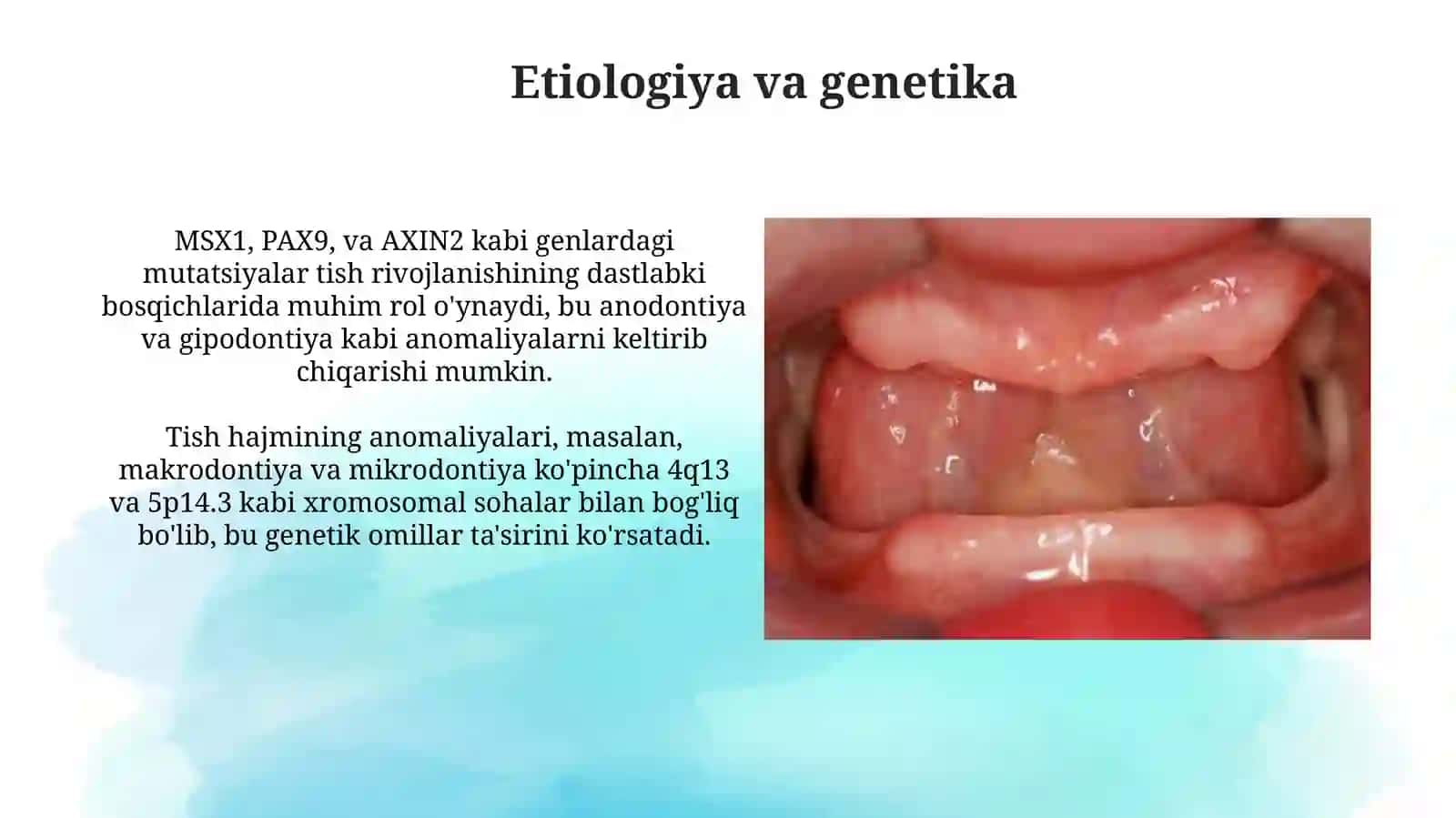 Tishlarning irsiy anomaliyalari (anodontiya, gipodontiya, makrodontiya,mikrodontiya) 4
