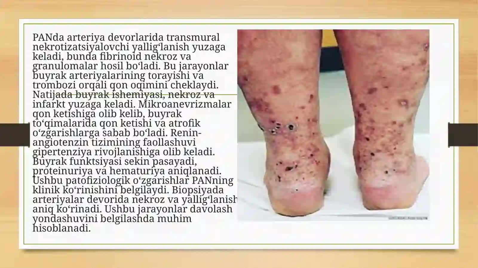 Tizimli vaskulitlar(tugunchali periartrit, nospetsefik aortoartrit, Vegener granulematozi)da buyraklarning zararlanishi xususiyatlari 4