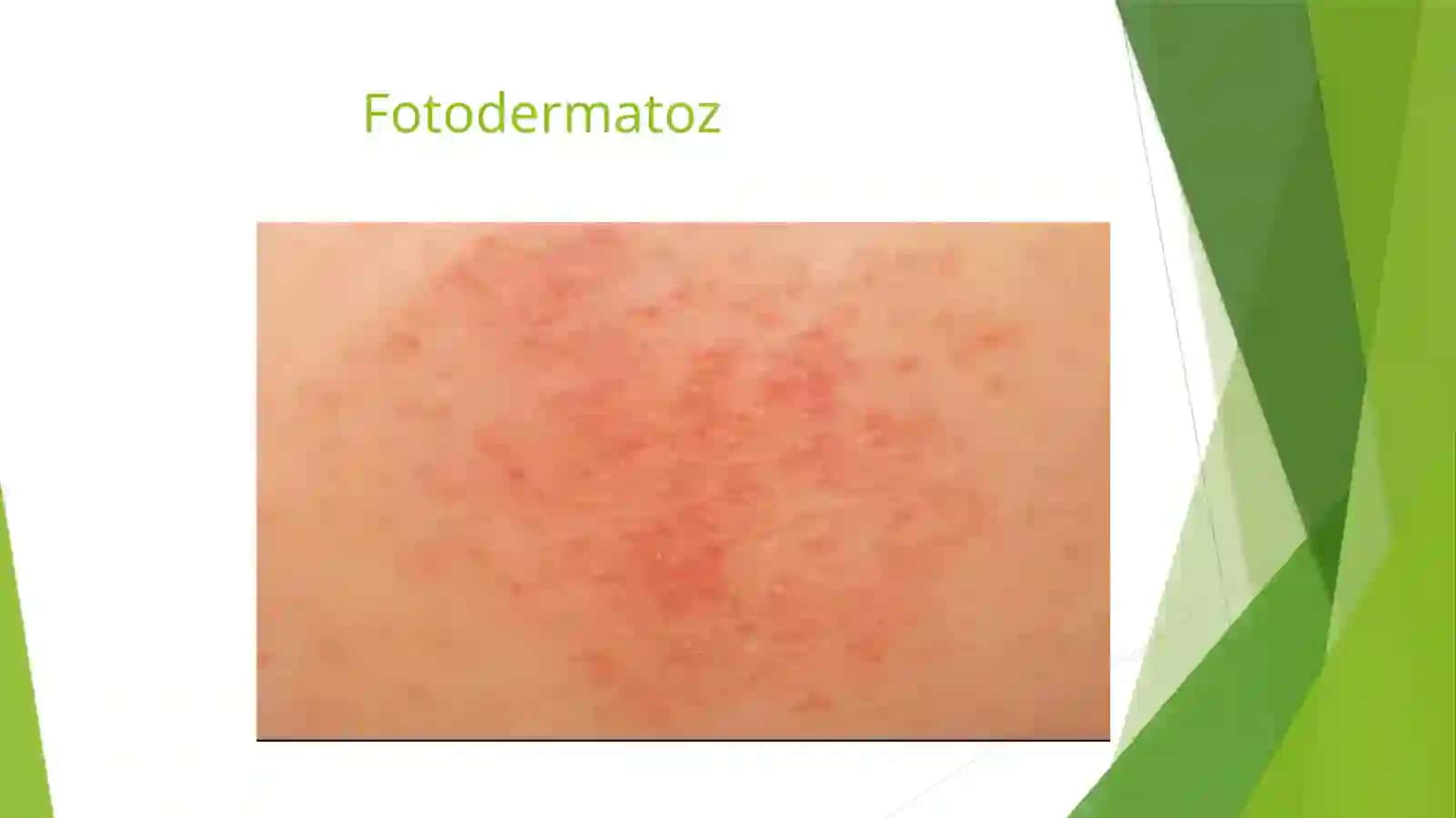 Fotodermatozlar va Melanoma va Baziloma  kasmitalogyadan 4