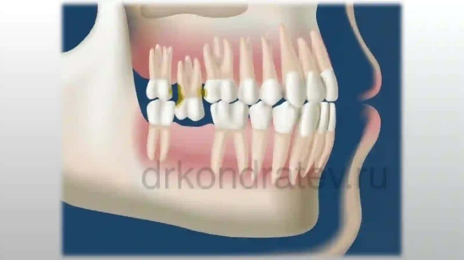 Tish qatori deformatsiyalarida okklyuziyani shakillantirishning gnatalogik asoslari 4