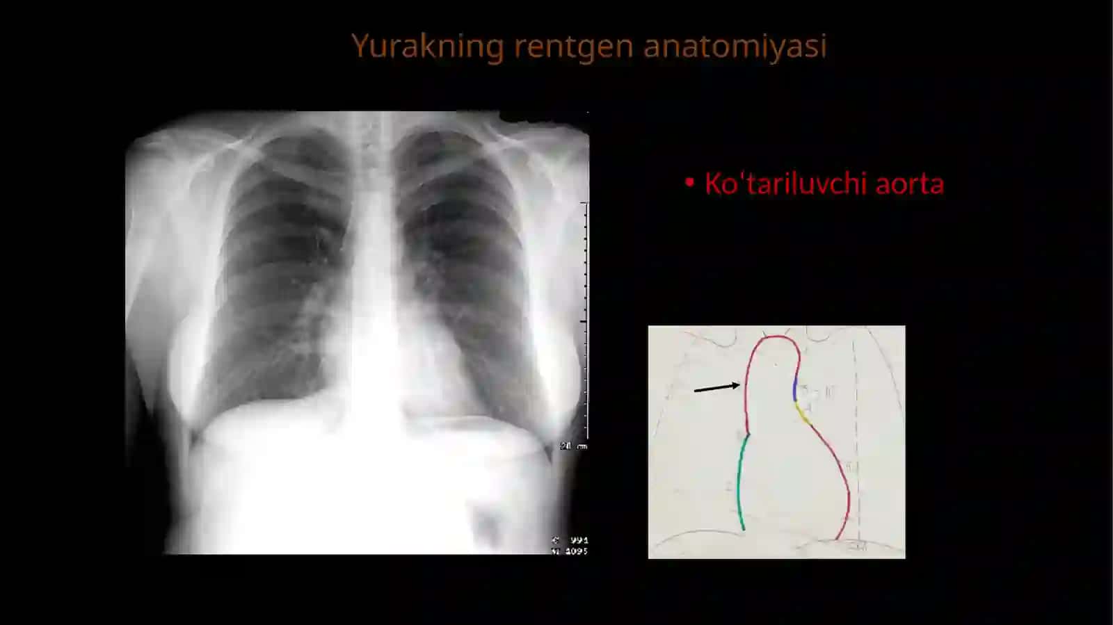 Yurak rentgenografiyasi 4
