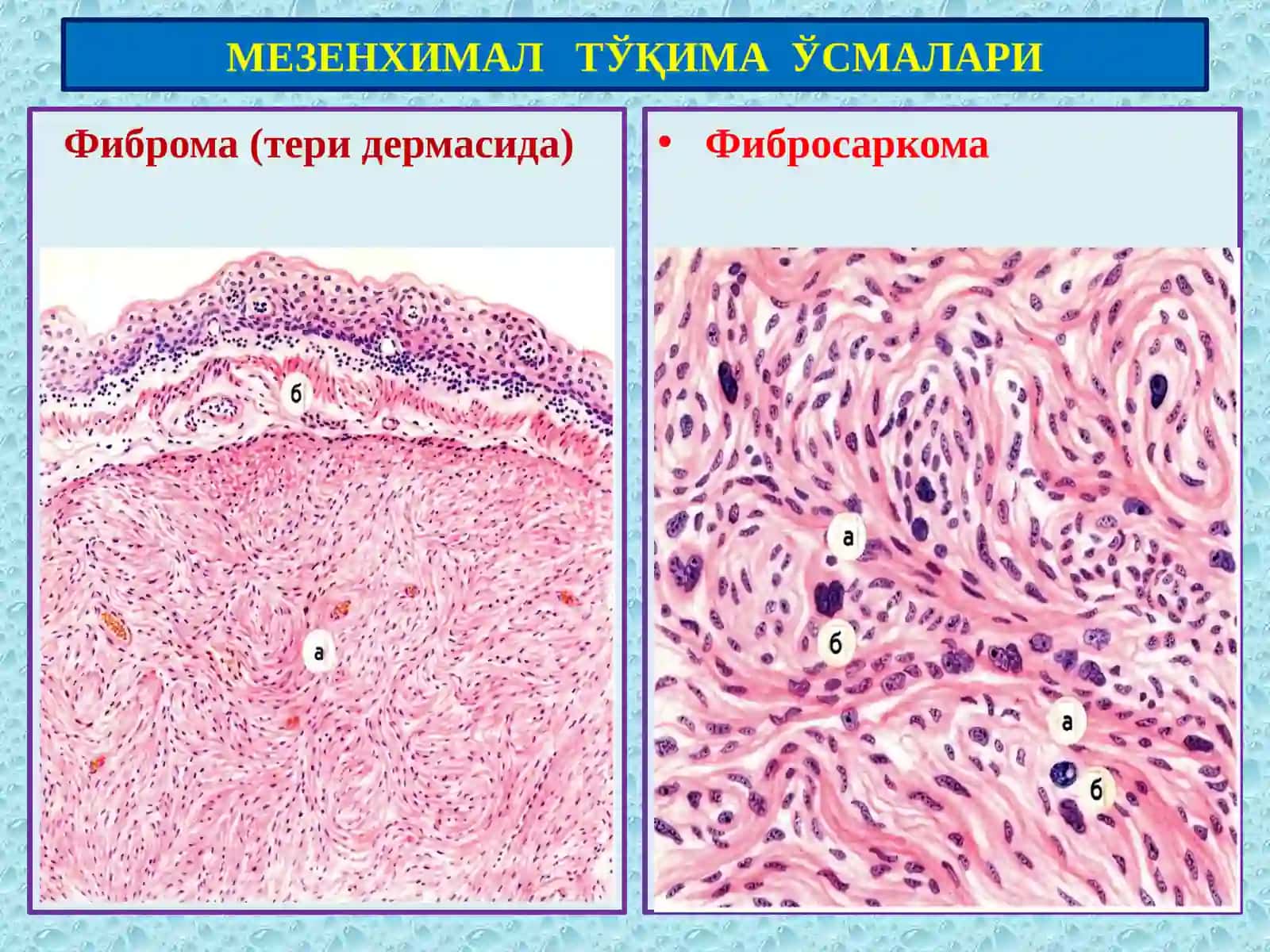 Мезенхимал,меланинли ва нерв тўқима ўсмалари 4