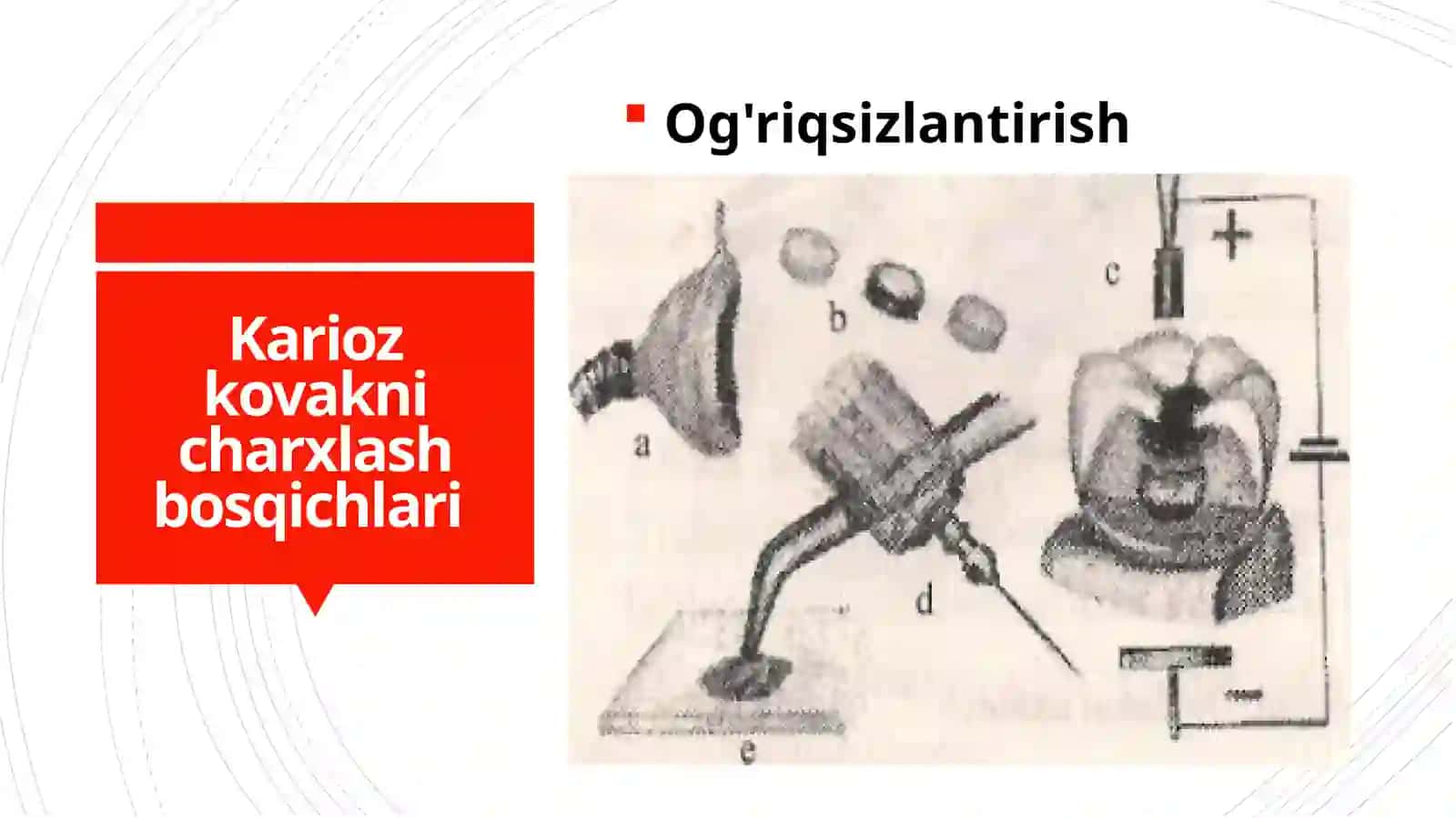Tish qattiq to'qimalarini charxlash bosqichlari va tamoyullari 4