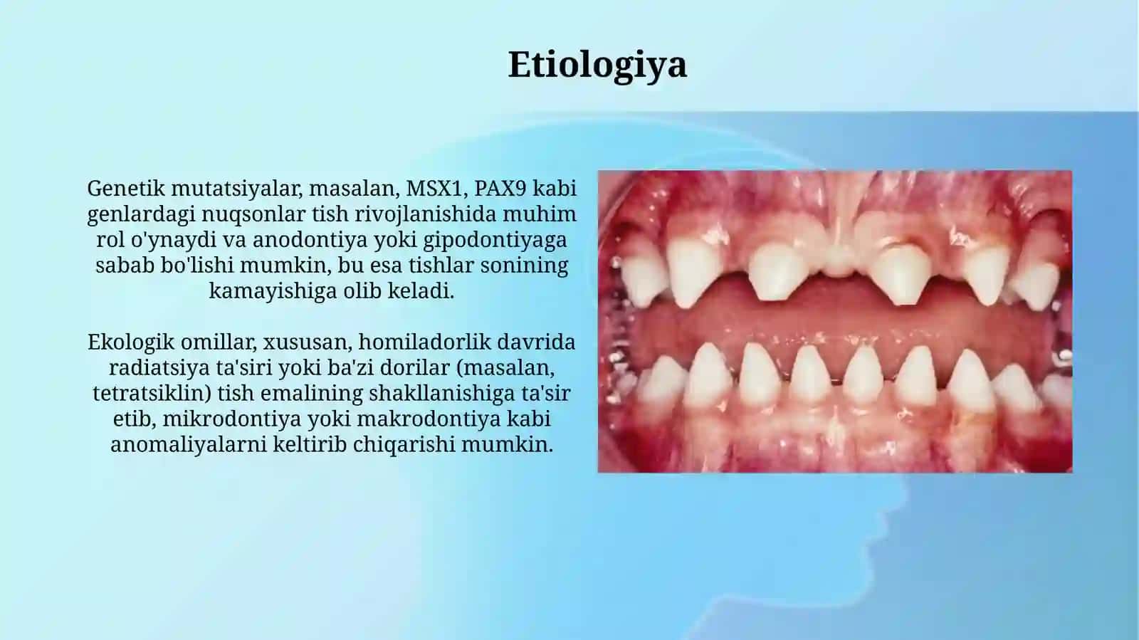 Tishlarning irsiy anomaliyalari (anodontiya, gipodontiya, makrodontiya, mikrodontiya) 4