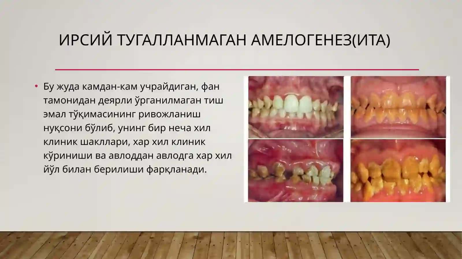 Тиш каттик тукимасининг наслий касалликлари 4