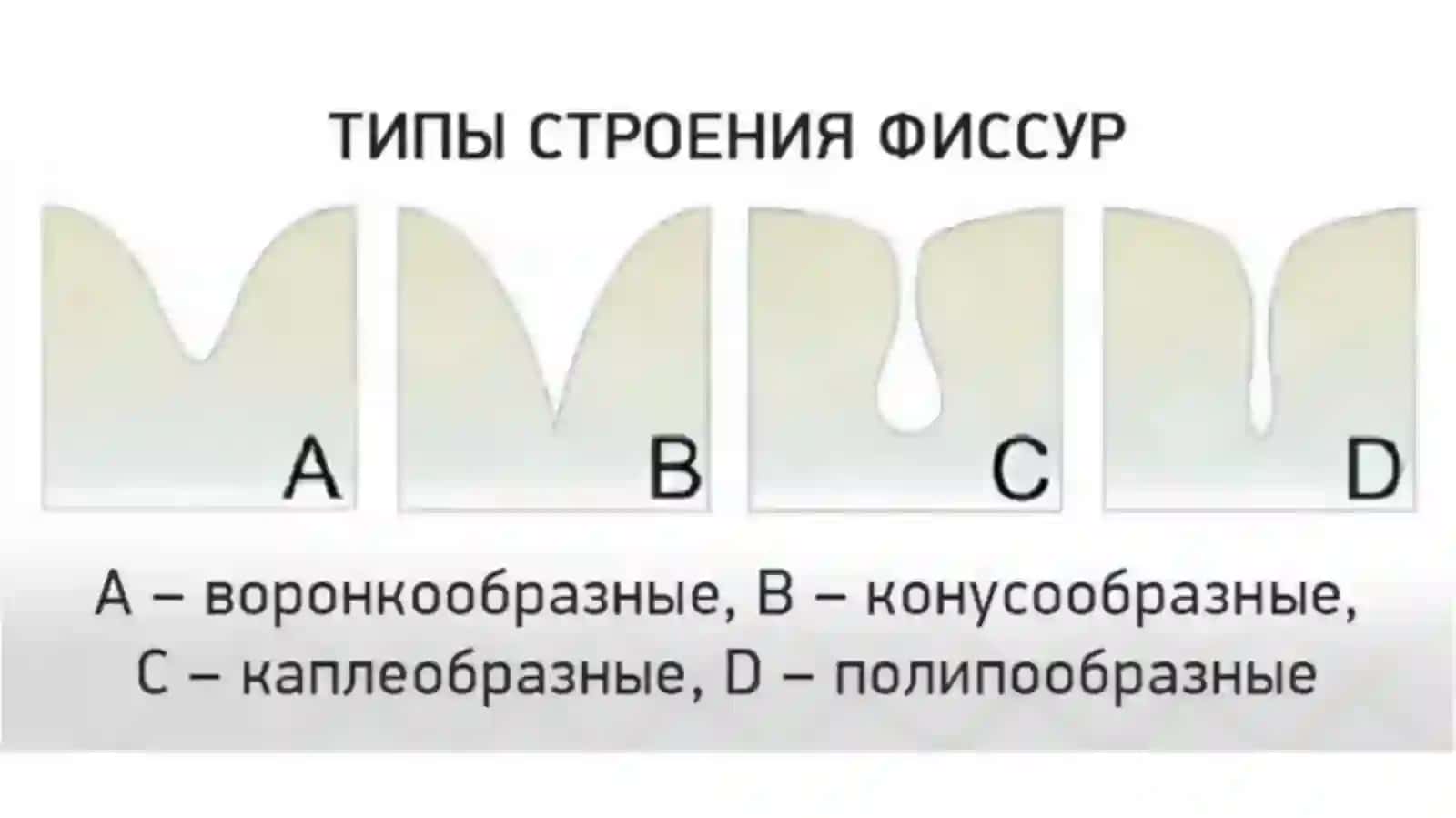 Герметизация фиссур 4