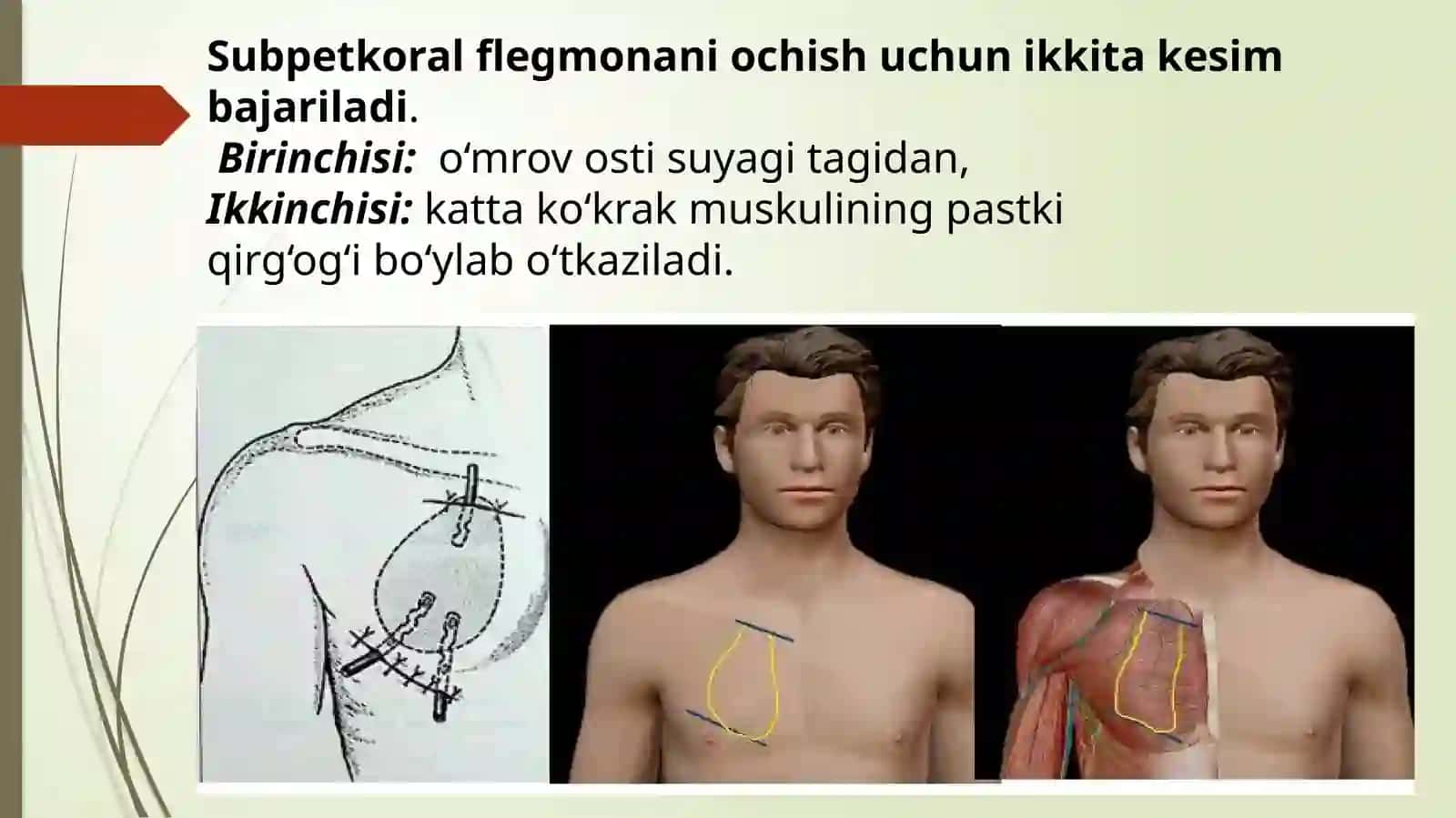 Subpektoral flegmonani ochish va drenajlash 4
